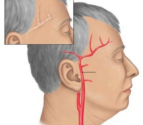 Болит левая сторона головы глаз висок