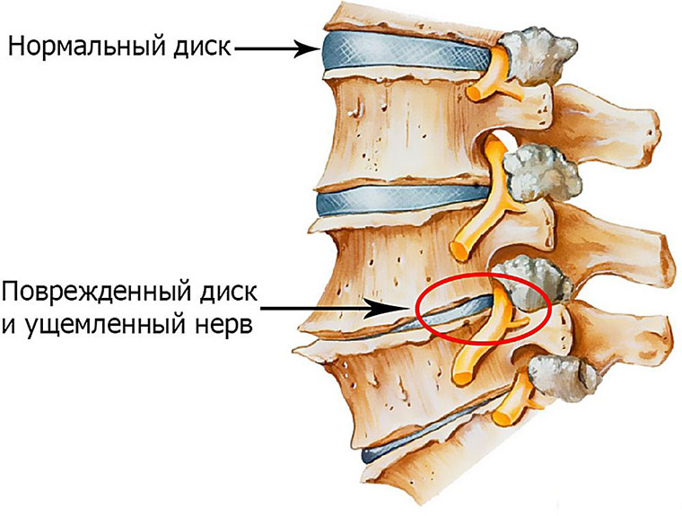При прогибе болит спина