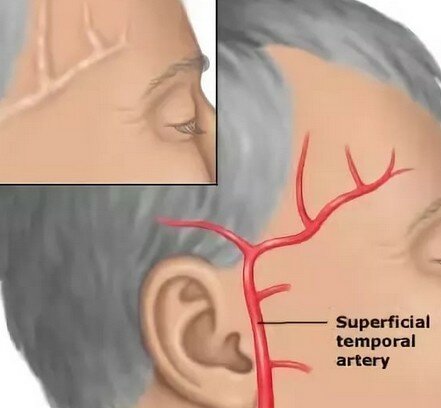 Болит голова правый висок что это может быть