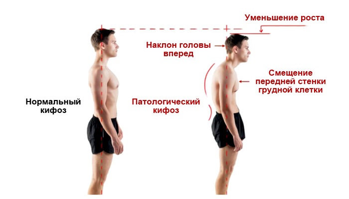 Внешние проявления кифоза