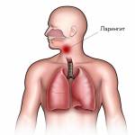 Чем характерен ларингит