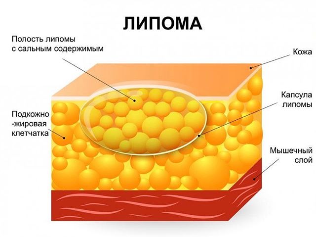 Мягкая шишка на спине болит