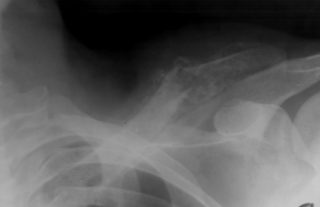 Болит ключица слева и голова