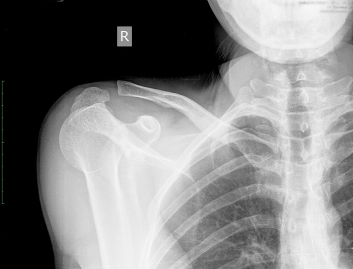 Болит ключица слева и голова