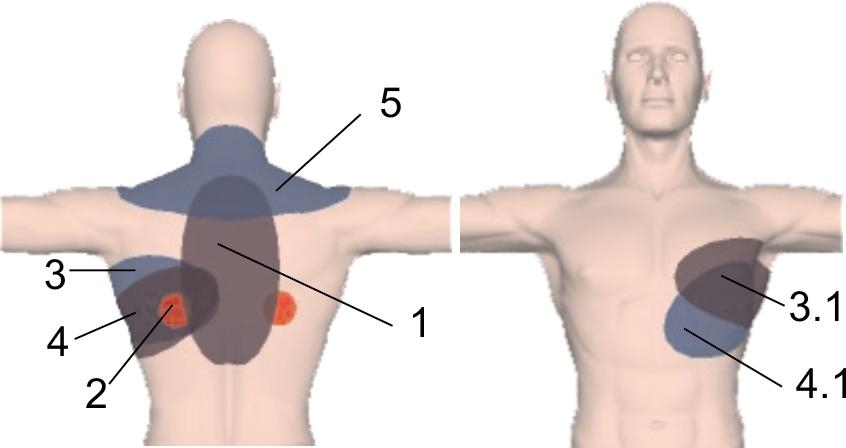 Боль при межреберной невралгии
