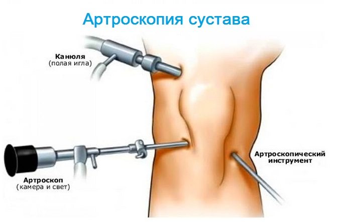 Артроскопия коленного сустава Артроскопия колена