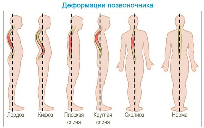 Отличие нормального позвоночника от деформаций Деформации позвоночника