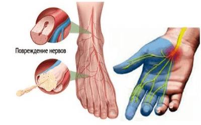 Полинейропатия