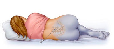 Действие эпидуральной анестезии на организм человека