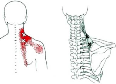 Почему болит ниже лопаток спина
