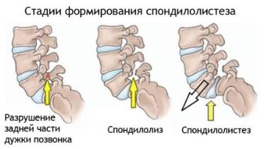 Спина болит с одной стороны особенно по ночам