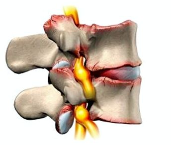 Спина болит с одной стороны особенно по ночам