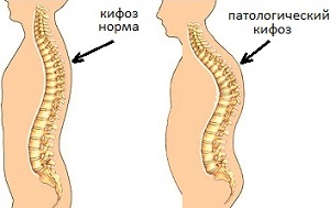 Искривление позвоночника Искривление позвоночника