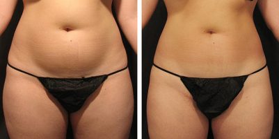 результат после процедуры результат прессотерапии