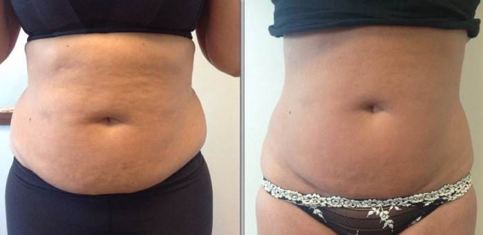 После прессотерапии болит спина