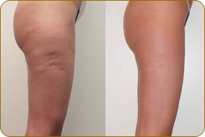 результат прессотерапии противопоказания и показания к прессотерапии