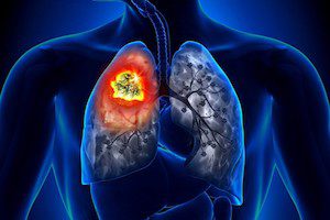 Рак легких Рак легких