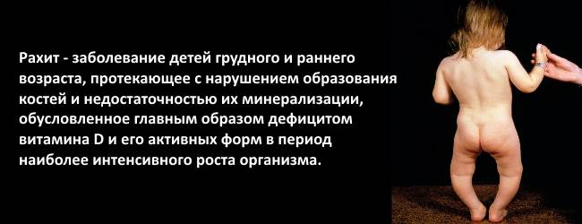 Причиной грудного кифоза может являться перенесенный в детстве рахит