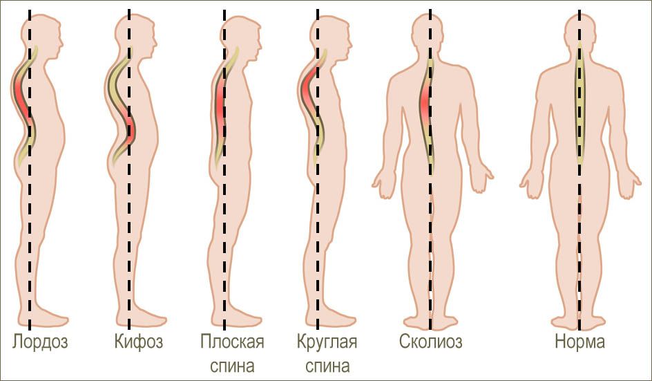 Лордоз, кифоз, сколиоз – наглядно Лордоз, кифоз, сколиоз – наглядно