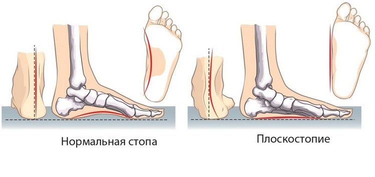 Отличие нормальной стопы от измененной при плоскостопии
