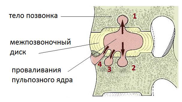 На рисунке – интракорпоральные повреждения