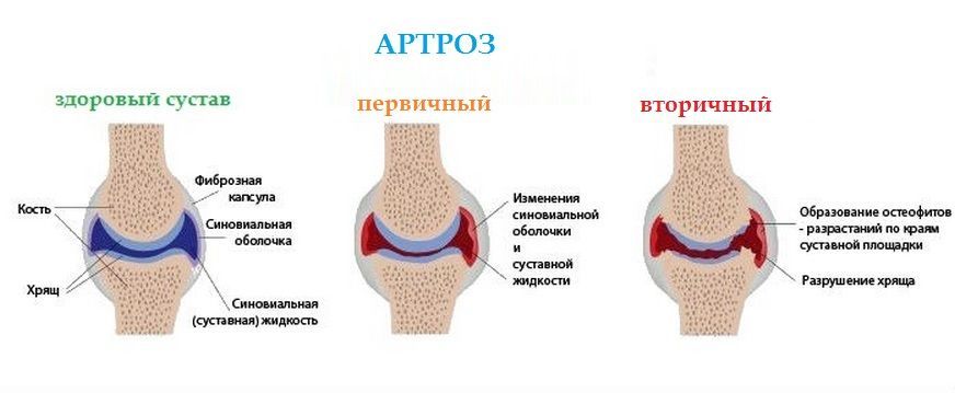 Анатомические особенности артроза Анатомические особенности артроза