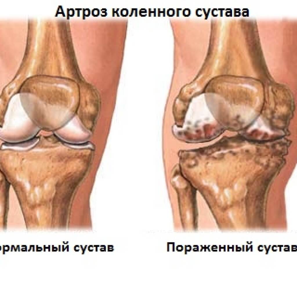 Артроз суставов приводит к истончению хрящевой прослойки Артроз суставов приводит к истончению хрящевой прослойки