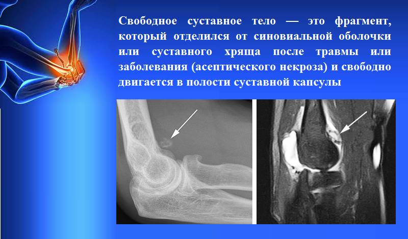Что такое свободное суставное тело (болезнь Кенига, рассекающий остеохондроз, суставная мышь) Что такое свободное суставное тело (болезнь Кенига, рассекающий остеохондроз, суставная мышь)
