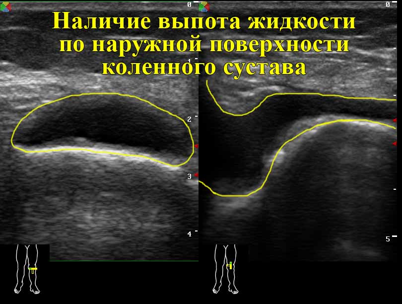 Для подтверждения выпота в колене проводят УЗИ сустава. Для подтверждения выпота в колене проводят УЗИ сустава.