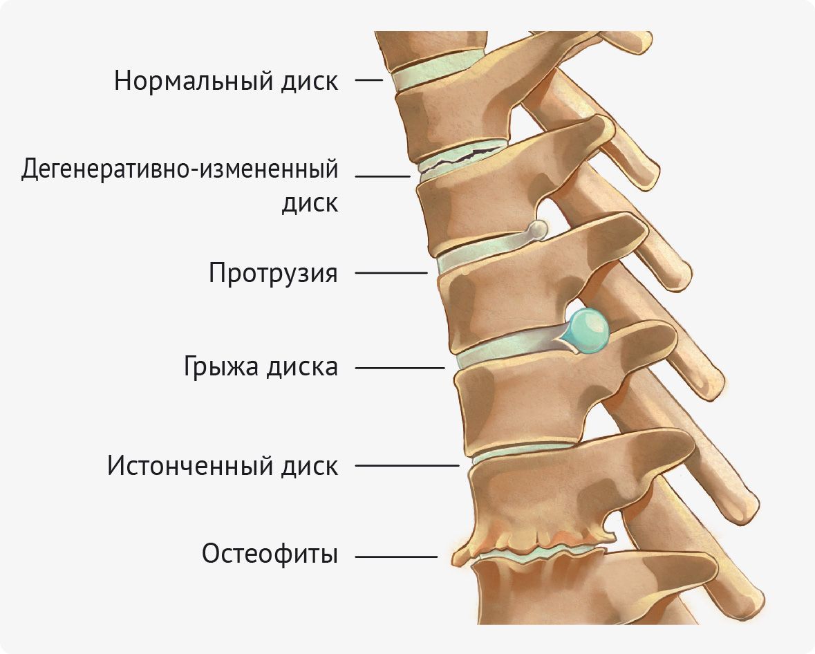 Дорсопатия шейного отдела позвоночника вызывает образование различных дегенеративных изменений Цервикальная дорсопатия вызывает образование различных дегенеративных изменений