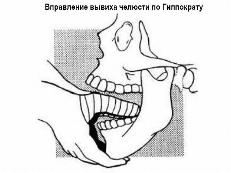 Физическое воздействие на челюсти при вправлении специалистом. Физическое воздействие на челюсти при вправлении специалистом.