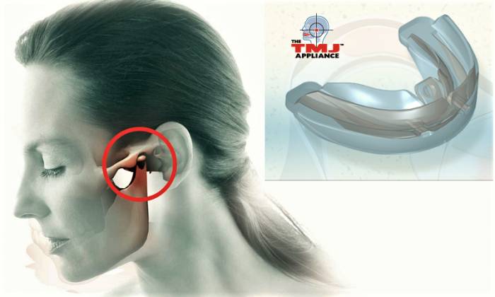 Форма крыловидной базы TMJ Appliance ™ великолепно расслабляет жевательные мышцы Форма крыловидной базы TMJ Appliance ™ великолепно расслабляет жевательные мышцы