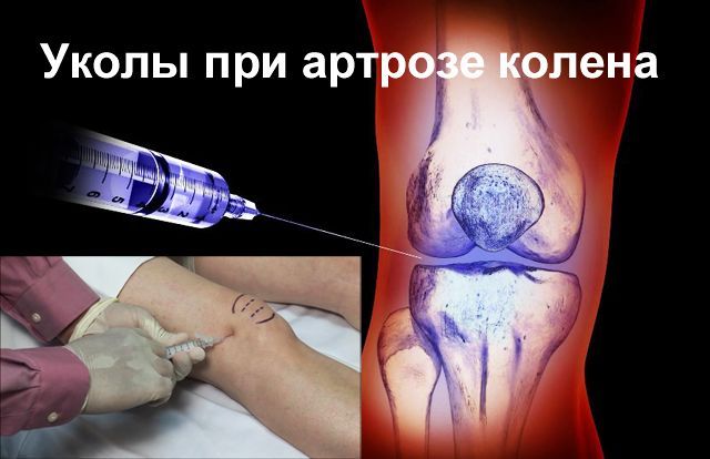 Инъекции при артрозе в колена приносят быстрый и действенный результат. Инъекции при артрозе в колена приносят быстрый и действенный результат.