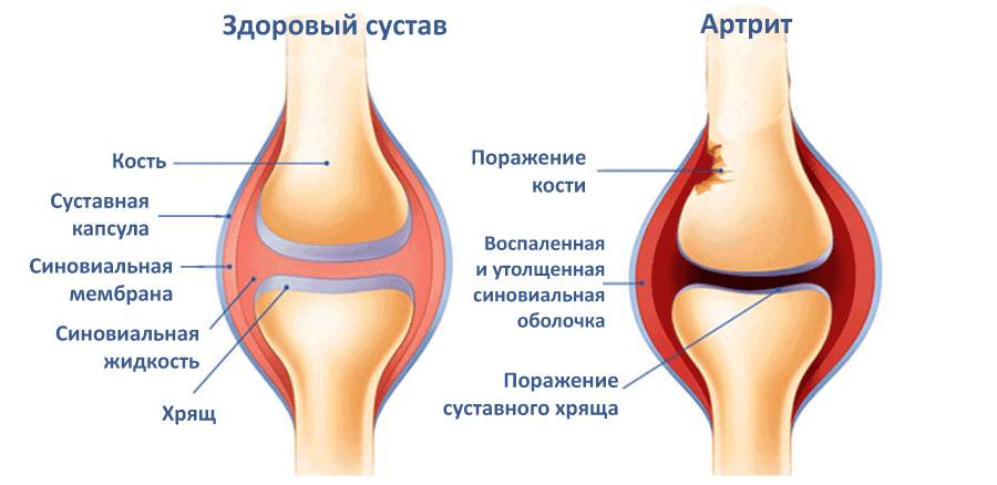 Как лечить заболевания суставов Как лечить заболевания суставов