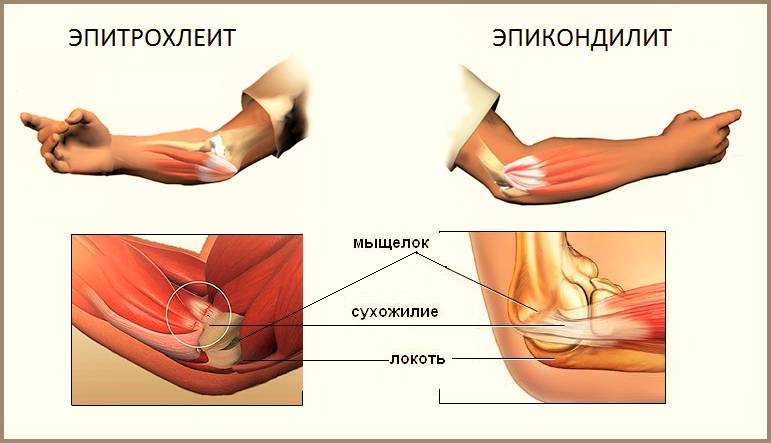 Медиальный эпикондилит (эпитрохлеит) и «Локоть теннисиста» (наружный эпикондилит) Медиальный эпикондилит (эпитрохлеит) и «Локоть теннисиста» (наружный эпикондилит)