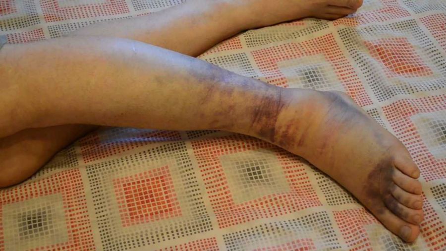 На фото полный разрыв связки голеностопного сустава На фото полный разрыв связки