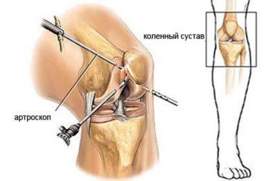 На колене часто выполняют частичное иссечение пораженных тканей, при этом выбирают малотравматичный тип оперативного вмешательства (на фото). На колене обычно выполняют частичное иссечение пораженных тканей, при этом выбирают малотравматичный тип оперативного вмешательства (на фото).