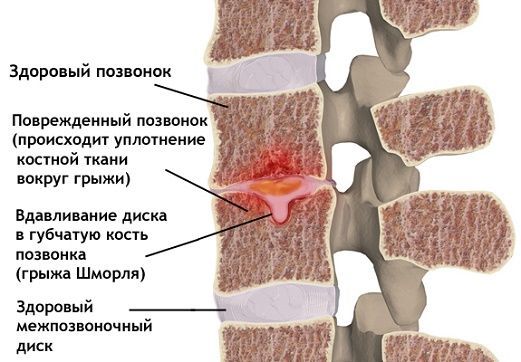 На рисунке показан центральный узелок Шморля с проваливанием вниз На рисунке показан центральный узелок с проваливанием вниз