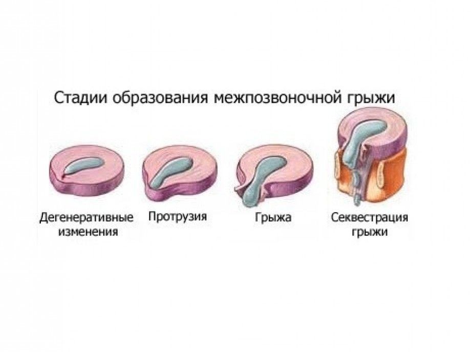 Обычно образование грыжевого выпячивания позвоночного столба проходит в несколько этапов. Обычно образование грыжевого выпячивания позвоночного столба проходит в несколько этапов.