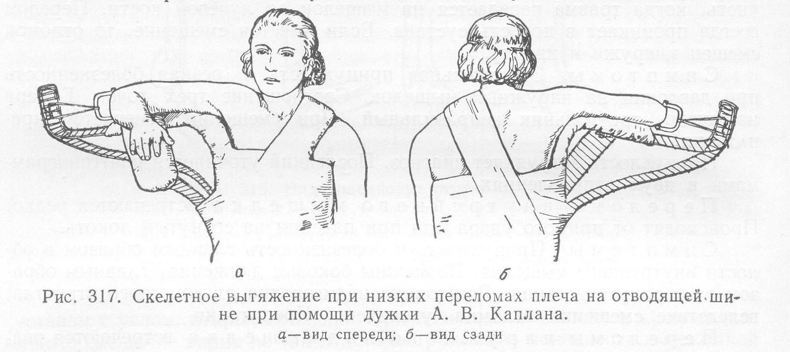 Одним из методов лечения является скелетное вытяжение Одним из методов лечения является скелетное вытяжение