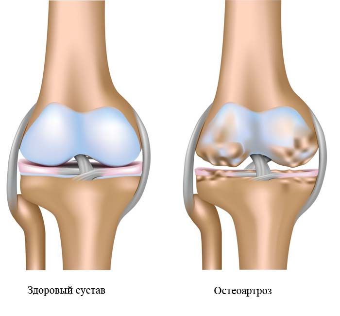 Остеоартроз – одна из причин, почему болят суставы рук Остеоартроз – одна из причин, почему болят суставы рук