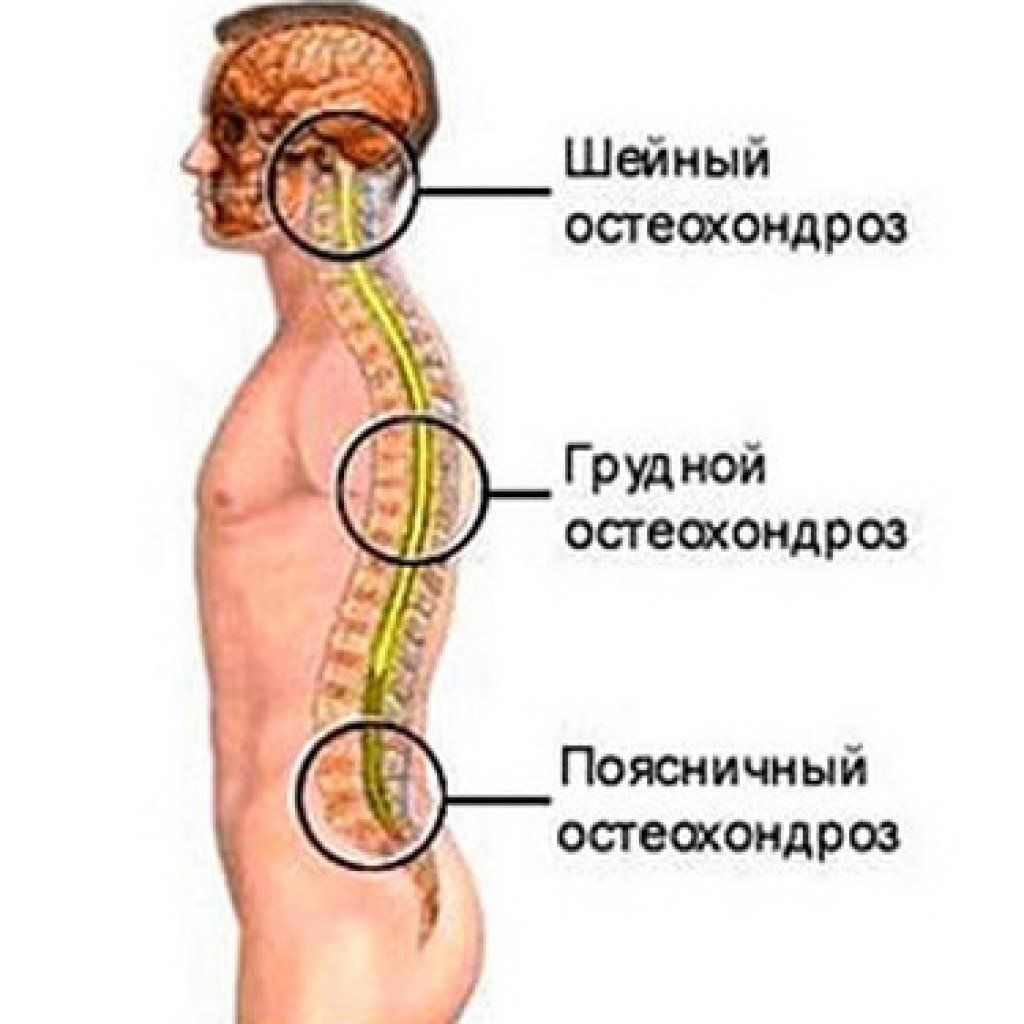 Остеохондроз – это патология любого из отделов позвоночника Остеохондроз – это патология любого из отделов позвоночника