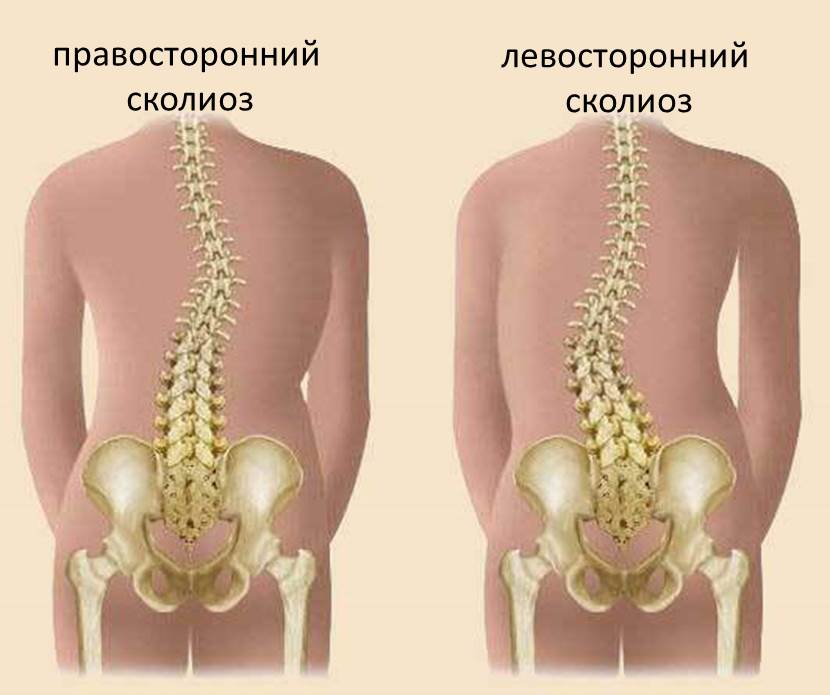 Правосторонний и левосторонний сколиоз Правосторонний и левосторонний сколиоз