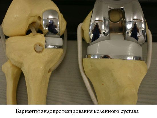 Разновидности эндопротезирования Разновидности эндопротезирования