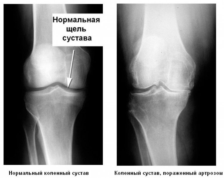 Рентген покажет изменения, что произошли в суставе. Рентген покажет изменения, что произошли в суставе.