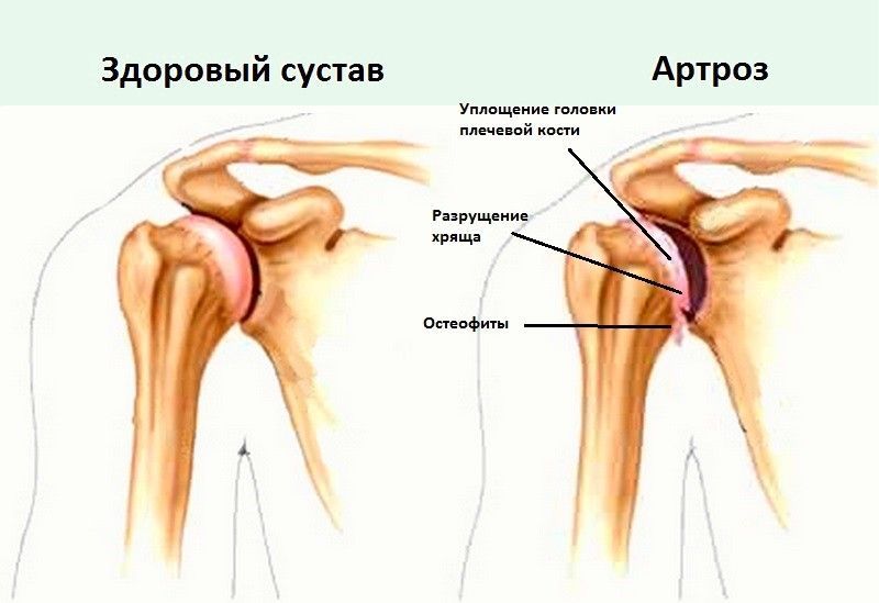 Риск повреждения плеча повышается при артрозе. Риск повреждения плеча повышается при артрозе.