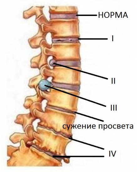 Симптомы при остеохондрозе поясничного отдела позвоночника напрямую коррелируют со степенью развития необратимых процессов в поясничных структурах Симптомы при остеохондрозе поясничного отдела позвоночника напрямую коррелируют со степенью развития необратимых процессов в поясничных структурах