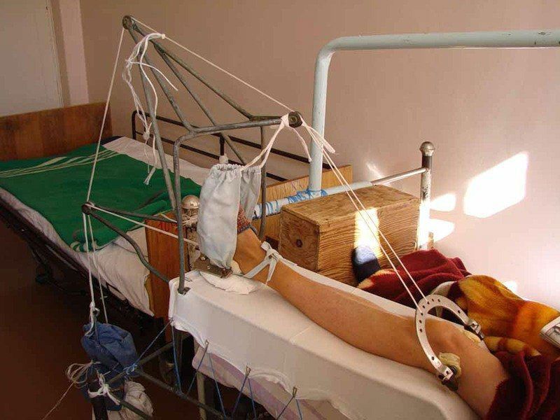 Скелетное вытяжение при переломе Скелетное вытяжение при переломе