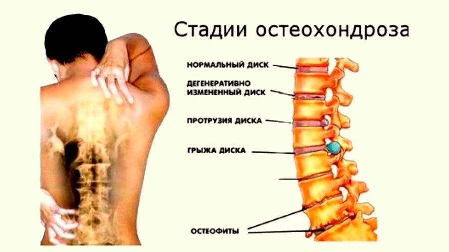 Стадии остеохондроза Стадии остеохондроза