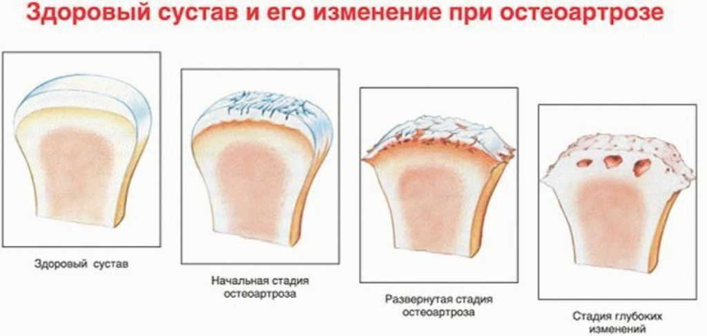 Существует 3 основные стадии (на фото) развития остеоартроза. Существует 3 основные стадии (на фото) развития остеоартроза.